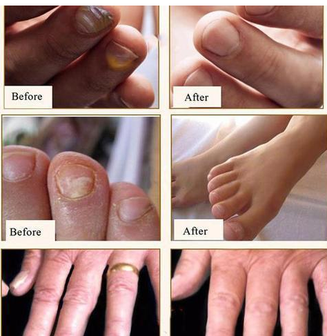 ADVANCED FUNGAL NAIL REPAIR PEN